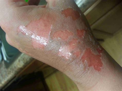 treating a rug burn|second degree friction burn.